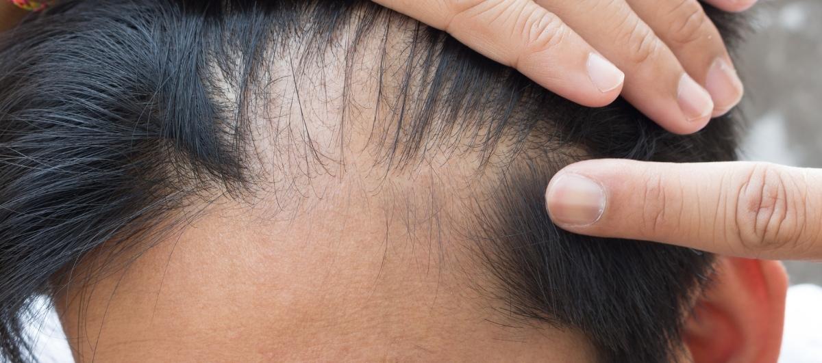 4 Must Try Natural Ingredients To Stop Hair Fall