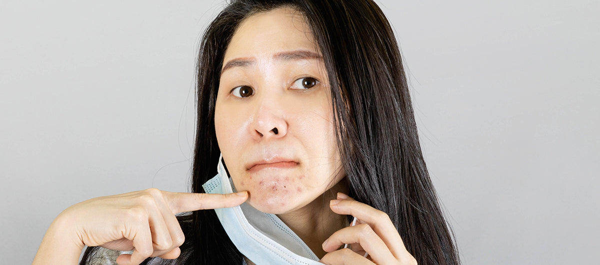 5 Easiest Tips To Avoid Maskne