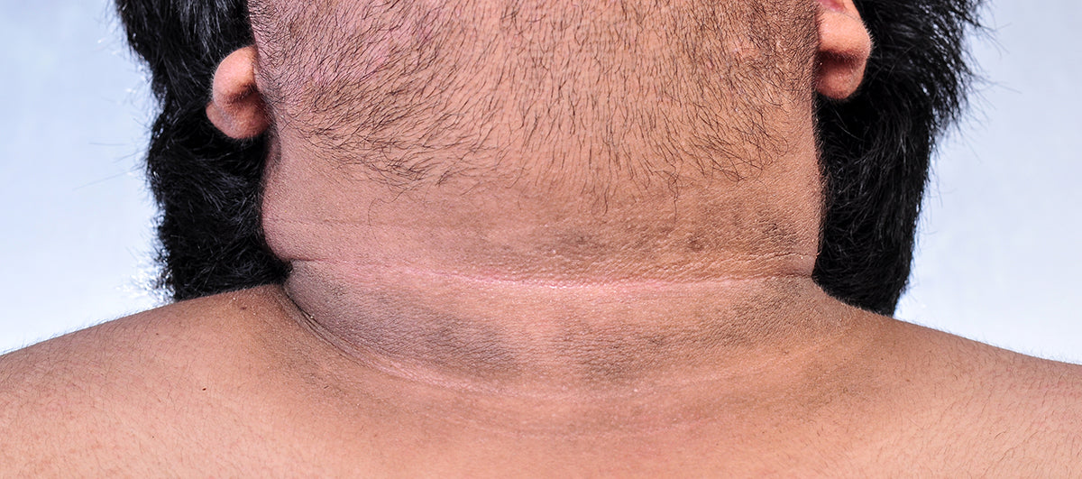 7 Effective Remedies To Treat Dark Neck
