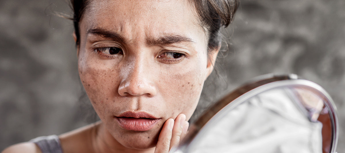 What Causes Skin To Darken And How To Deal With It - Re'equil