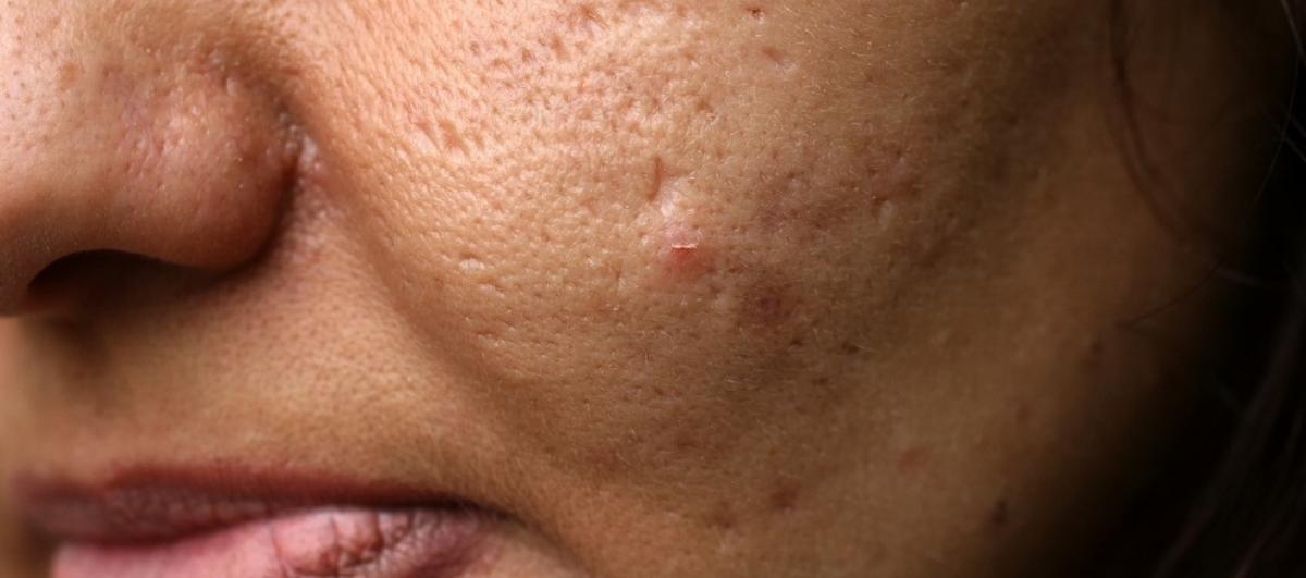 Alert! This TYPE of Acne Can Give You Acne Scars - Re'equil