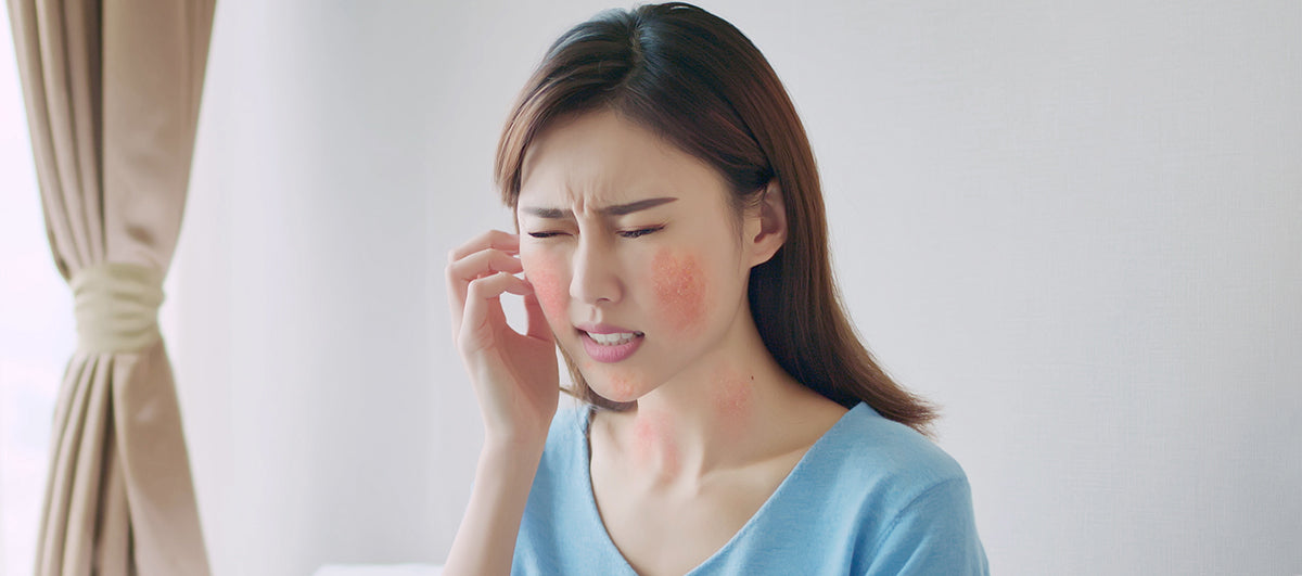 Everything You Need To Know About Atopic Dermatitis