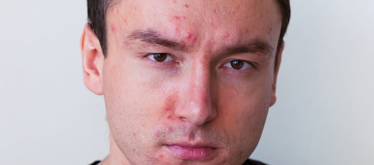 Zinc PCA for acne-prone skin? All you need to know - Re'equil