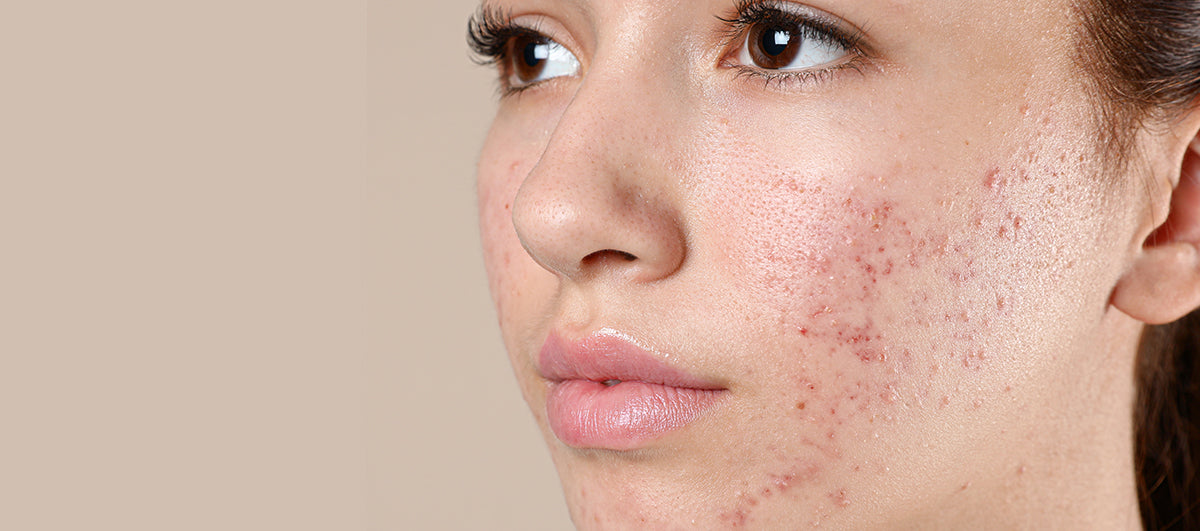 Oily shop skin acne