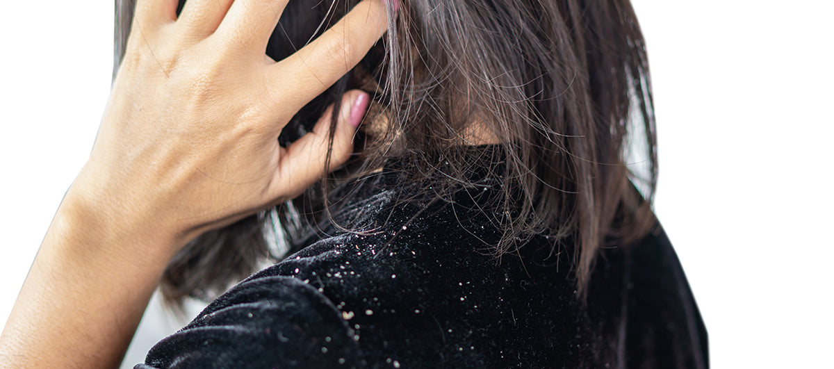 Best Remedy For Dandruff