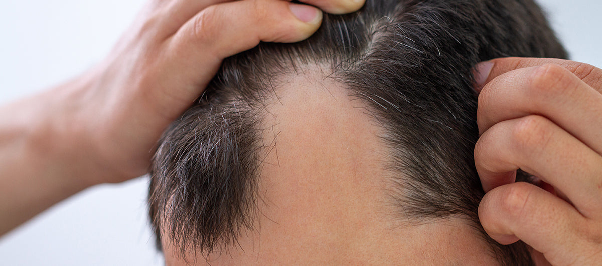 AnaGain And Aminexil For Hair Loss