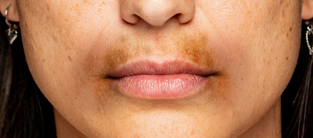 How Can I Effectively Address & Lighten Dark Patches Around the Mouth?