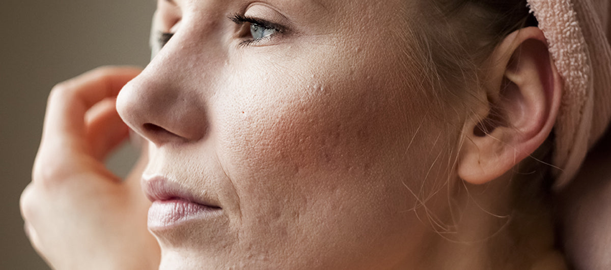 Acne pores sales