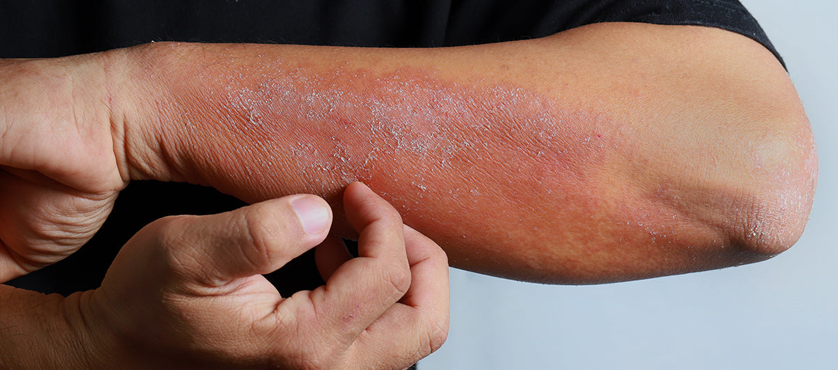 How Does Oatmeal Help with Atopic Dermatitis?