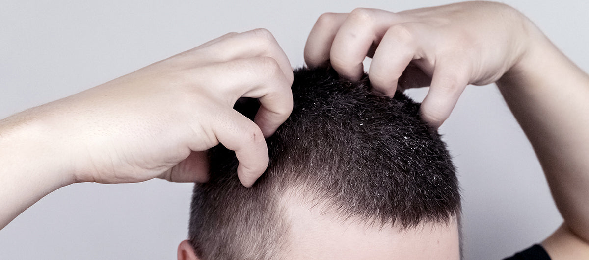 Effective Ways To Treat Itchy Scalp In Winters