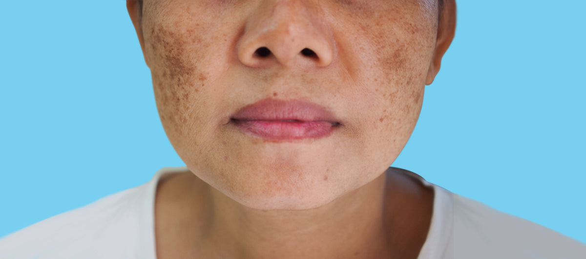 3 Startling Things I wish I knew About Hyperpigmentation - Re'equil