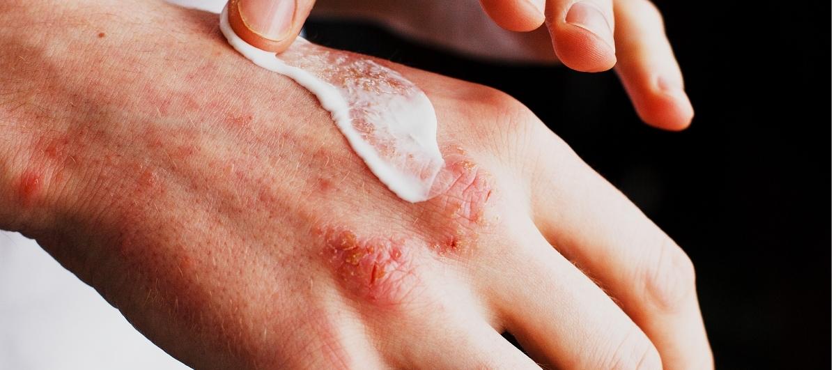 How Does Cold Weather Flare Up Eczema? 6 Effective Tips To Prevent It - Re'equil