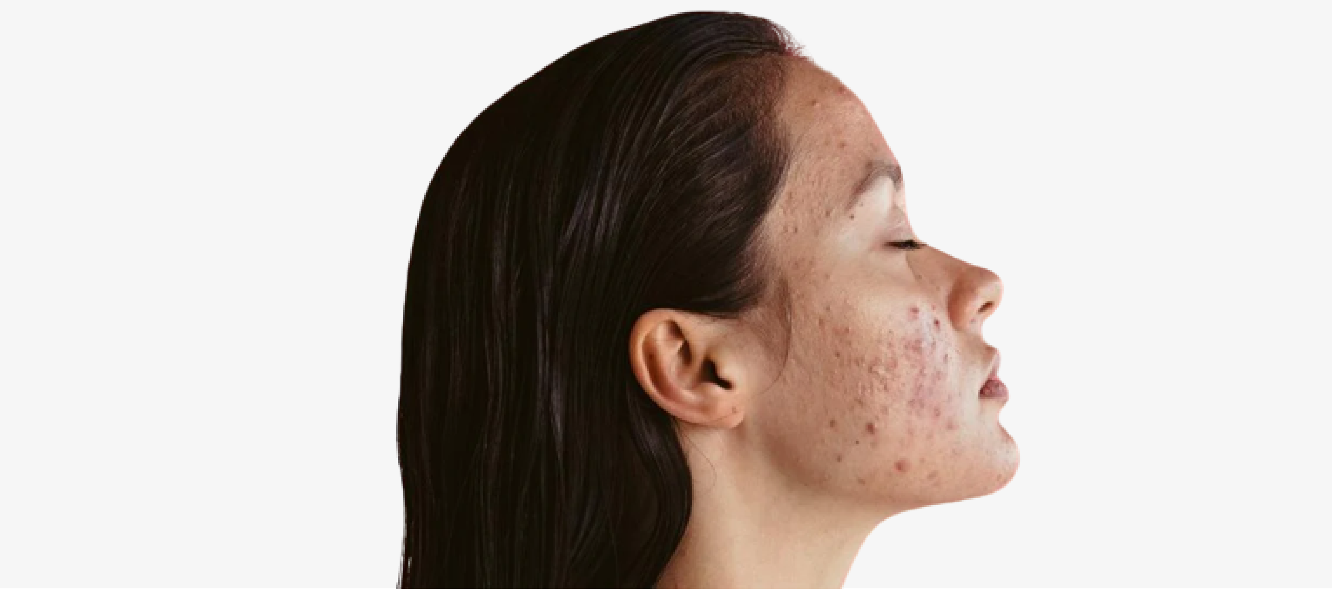 Mastering Clear & Healthy Skin: Practical & Effective Tips to Prevent Acne & Acne Scars - Re'equil