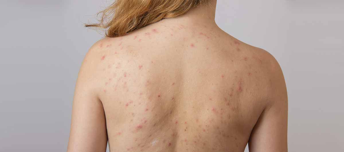 Get Rid of Back Acne | What causes it and how to treat it - Re'equil