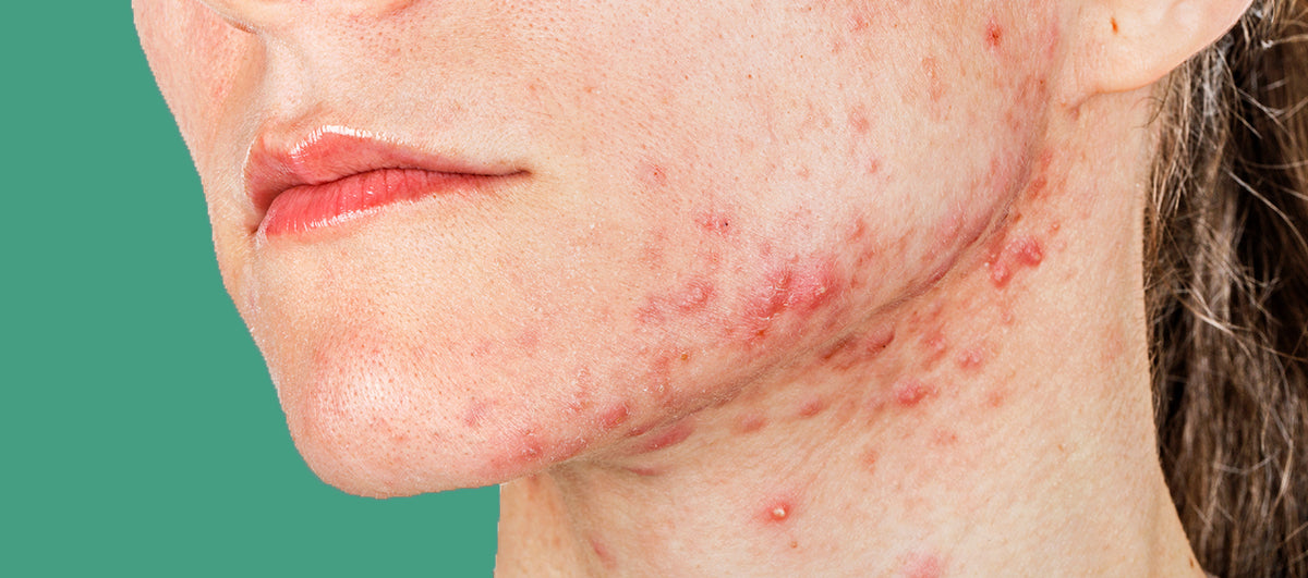 Get Acne-Clear Skin In 7 Weeks Even If You Do Not Follow A Basic Skincare Regimen