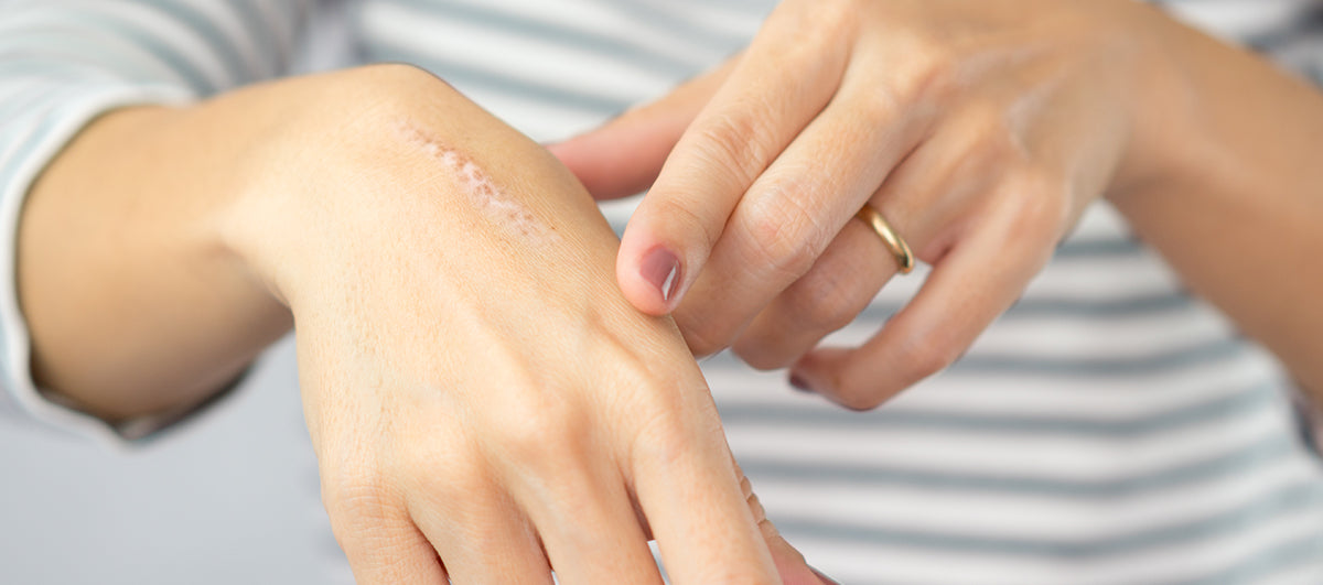 How To Get Rid Of Burn Marks And Scars At Home - Re'equil