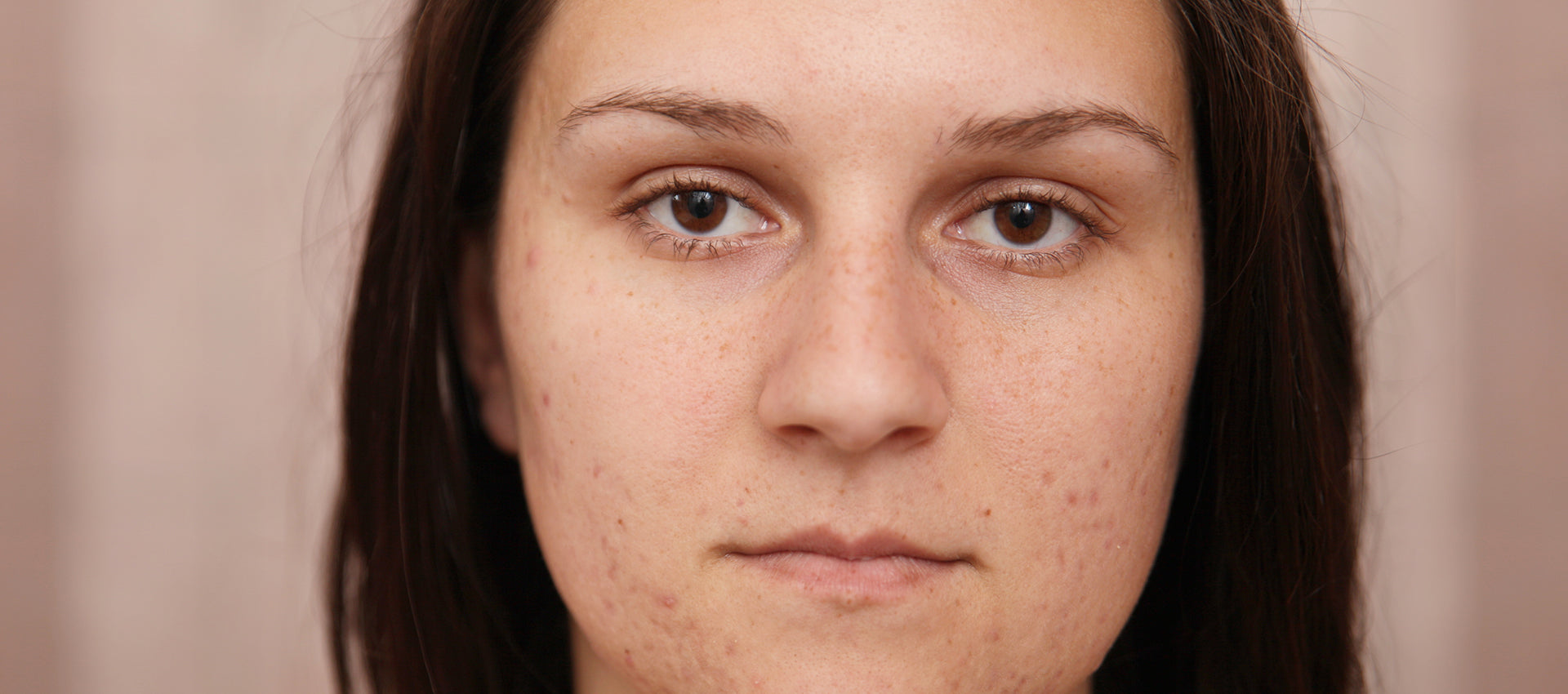 How To Get Rid Of Old Acne Scars Naturally