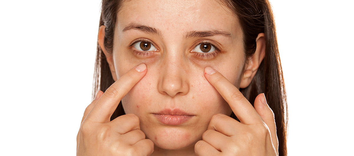 How To Treat Dark Circles Naturally - Re'equil