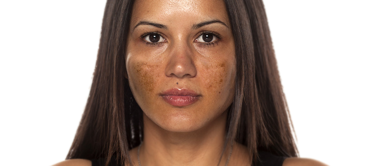 How To Get Rid Of Hyperpigmentation - Re'equil