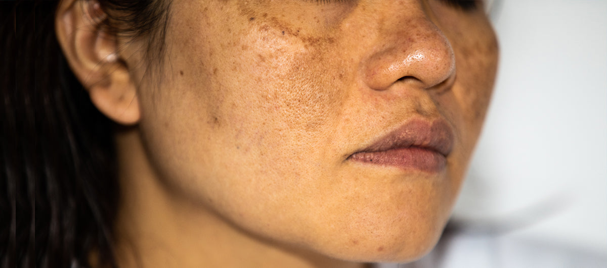 Laser Treatment For Pigmentation
