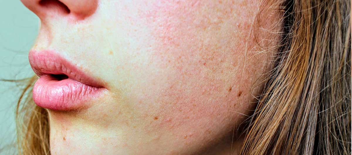 Myths about Acne