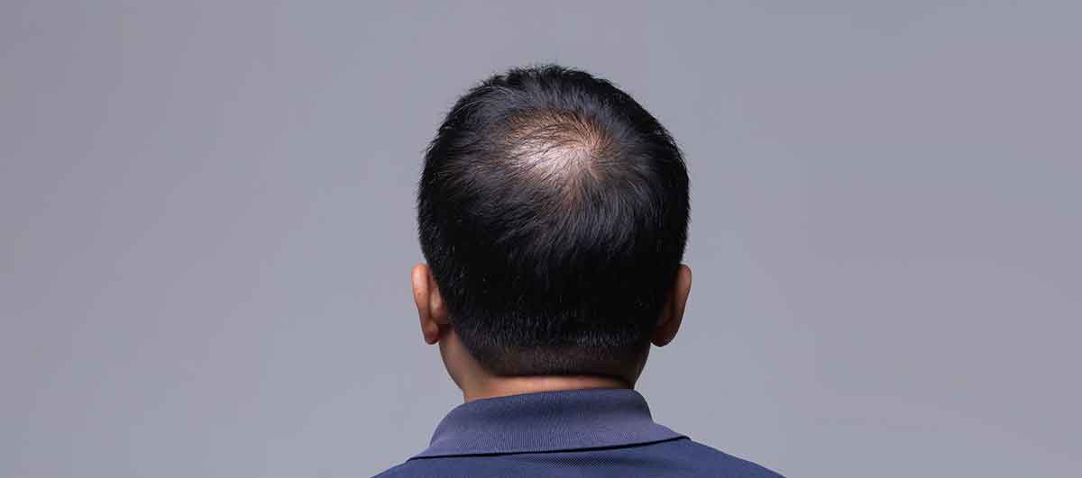 Natural Treatments for Thyroid Effects on Hair and Skin - Re'equil