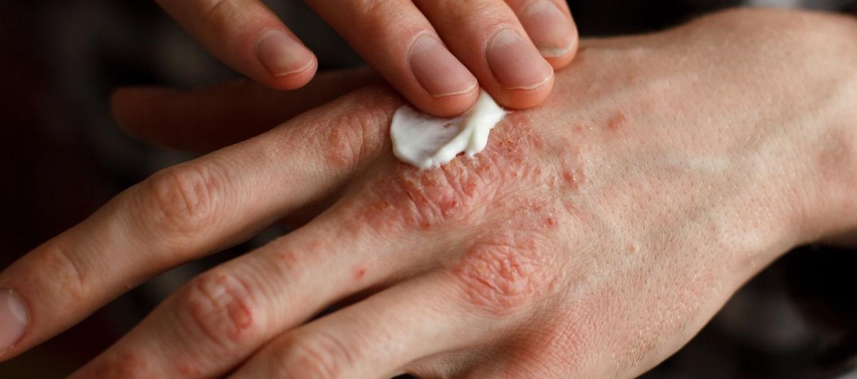 10 Effective Ways To Tame Hand Eczema - Re'equil