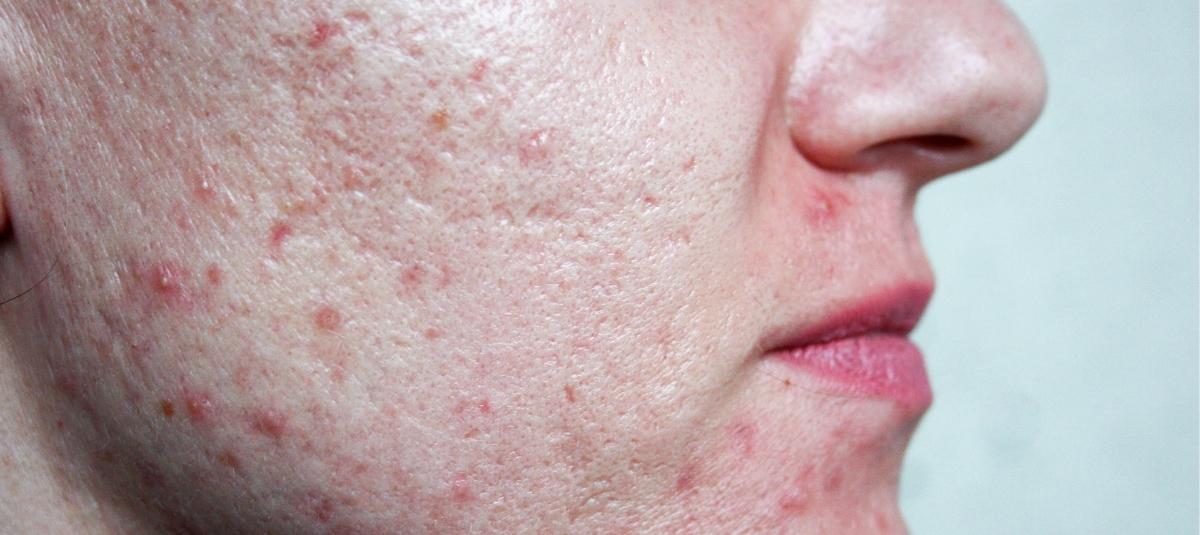 Acne pores outlet