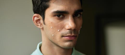 The Ultimate Guide to Acne Care and Acne Spots Removal - Re'equil