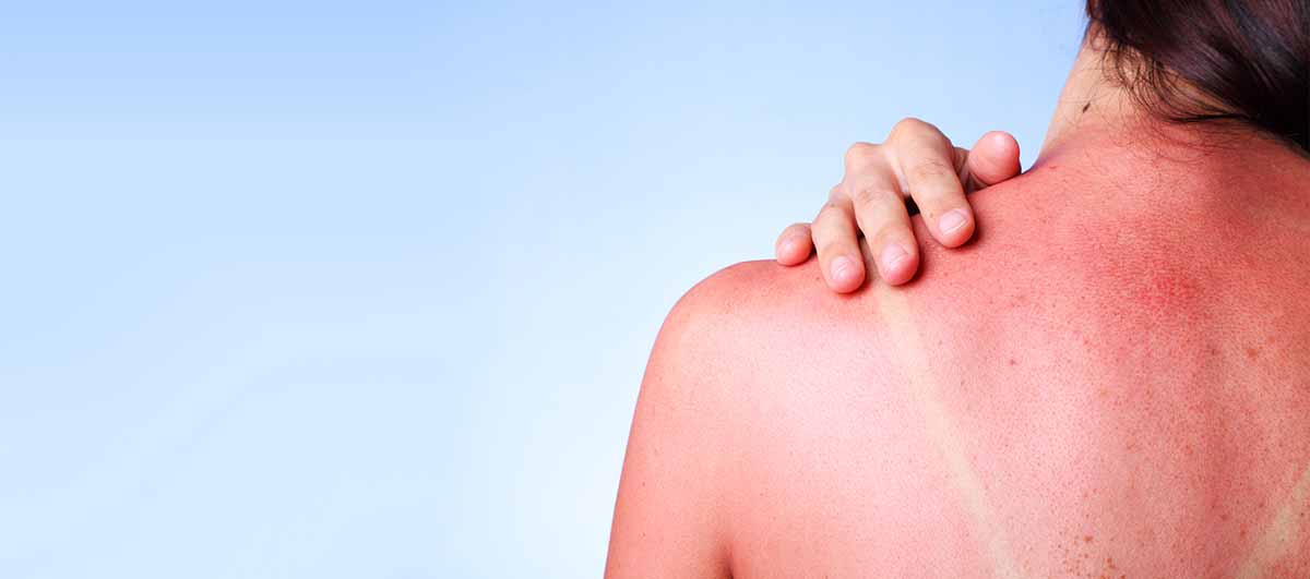 Home Remedies for Sunburn