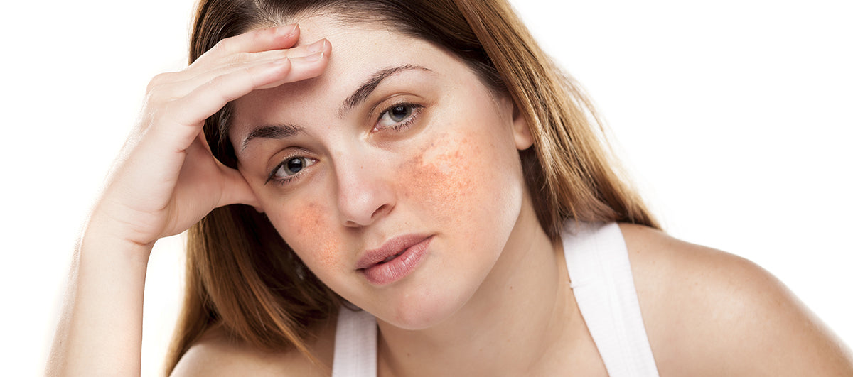 Have You Been Doing Your Hyperpigmentation Skin Care Wrong (And Does It Really Matter) - Re'equil