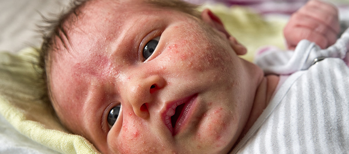 Top 5 Causes Of Acne In Toddlers - Re'equil