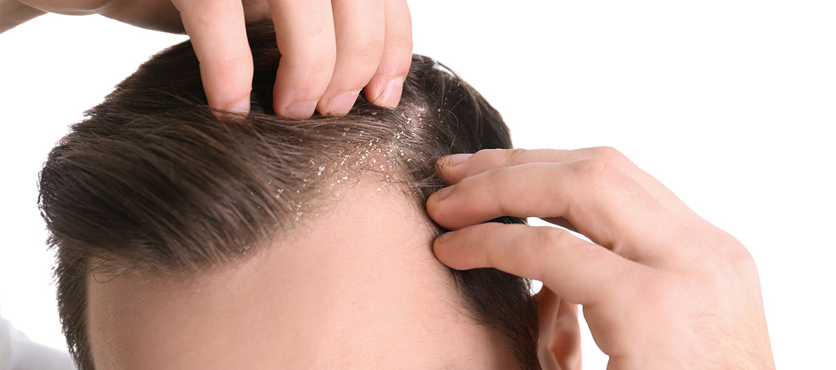 Top 5 Causes Of Dandruff