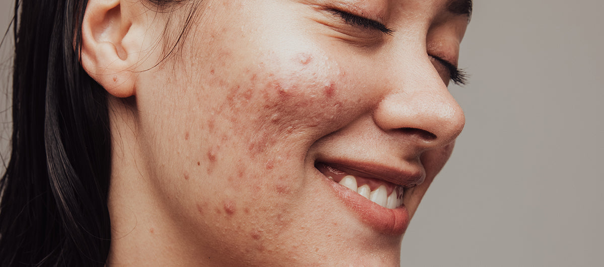 Top 5 Powerful Things You Must Tell Yourself Today To Get Over Your Acne Fears in 2021