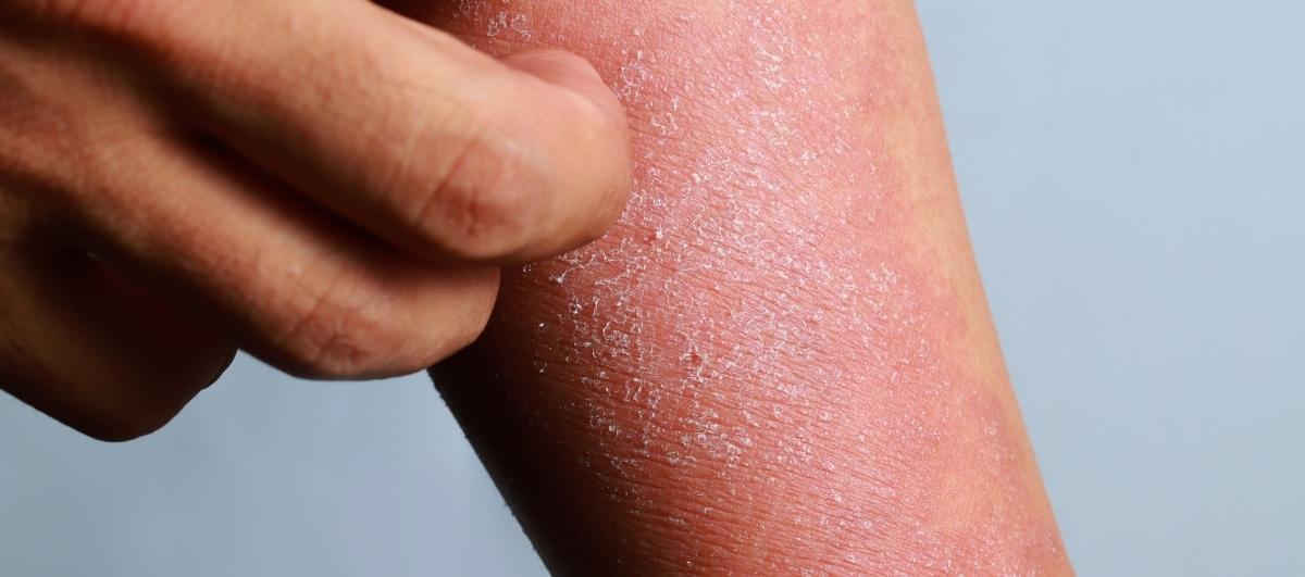 5 Helpful Tips to Manage Eczema Flare-Ups in Summer