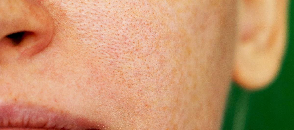 Top 7 Home Remedies For Open Pores - Re'equil