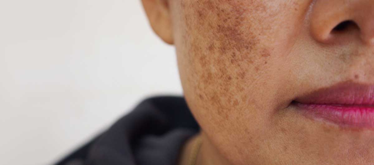 Hack Hyperpigmentation; From Types, Causes to Solutions