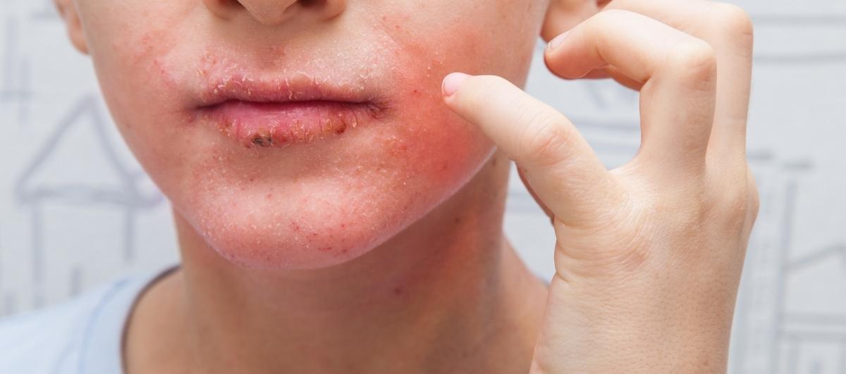 4 Preventive Tips to Manage Face Eczema - Re'equil