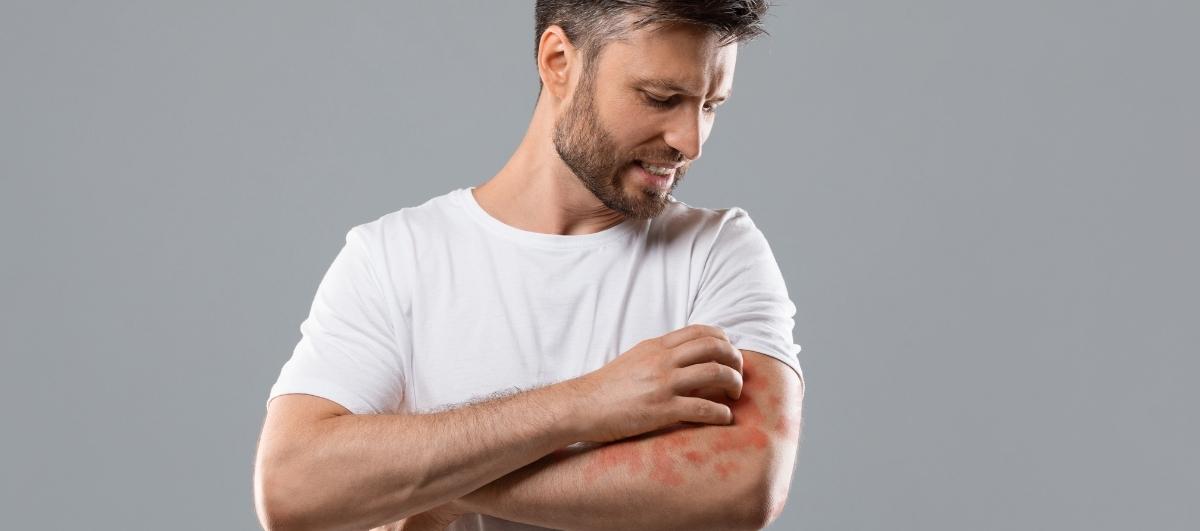 Atopic Dermatitis (Eczema) : Causes, Triggers, And Prevention Tips