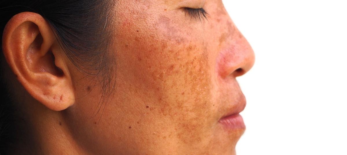 Know How Skipping This One Step Can Worsen Melasma - Re'equil