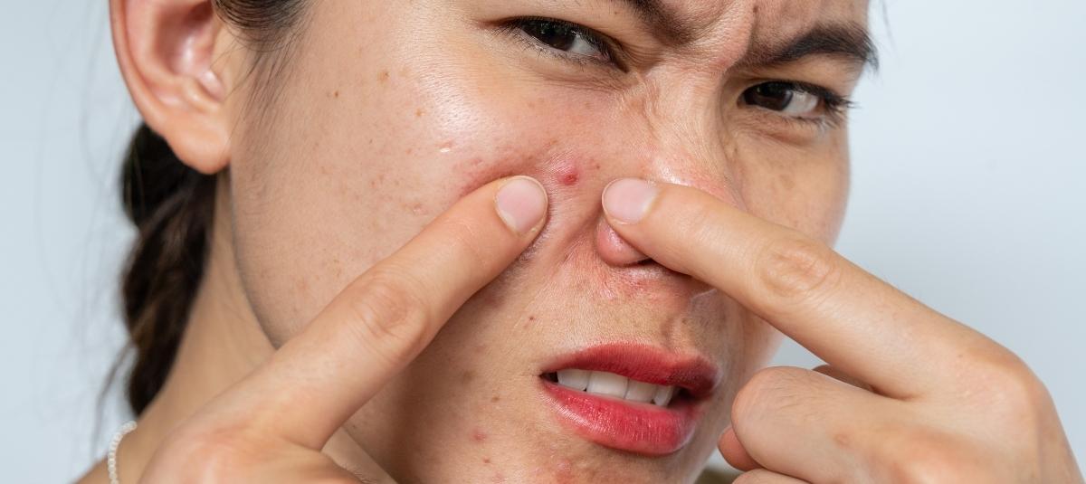 8 Effective Tips To Control Monsoon Acne - Re'equil