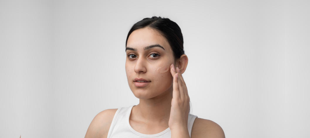 A Comprehensive Guide on Hormonal Acne - Re'equil