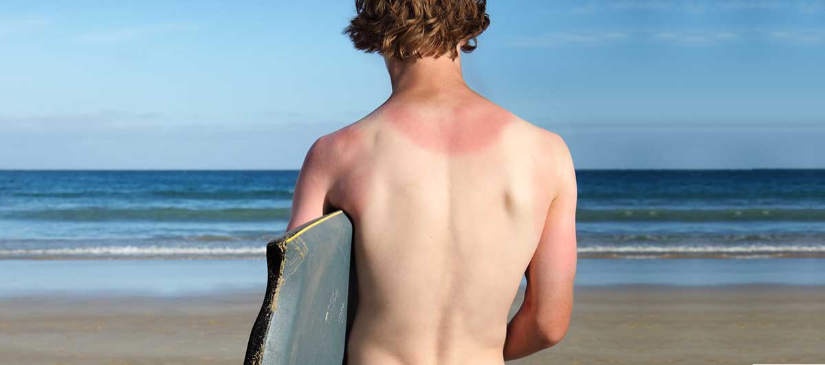 Sunburn - Causes And Prevention - Re'equil