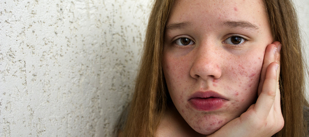 What are the various types of Acne