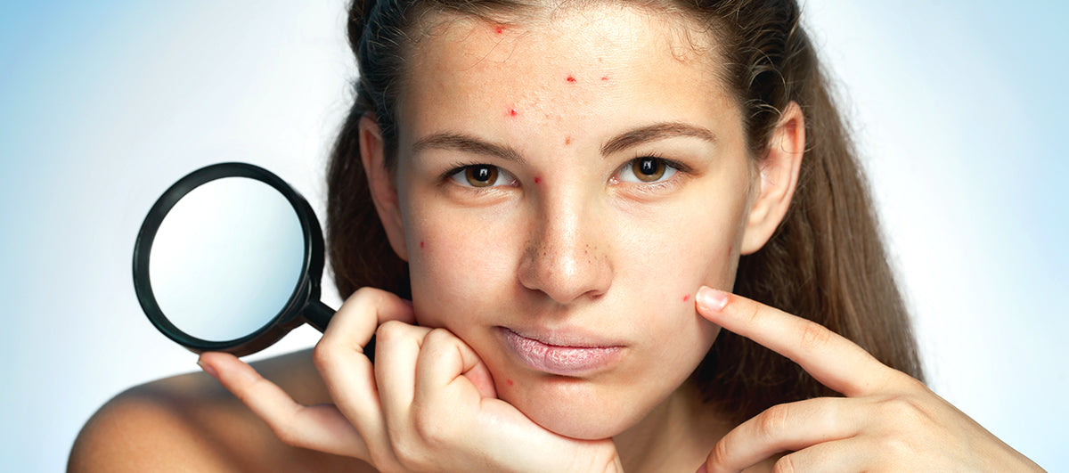 What Causes Acne On Cheeks And Forehead?