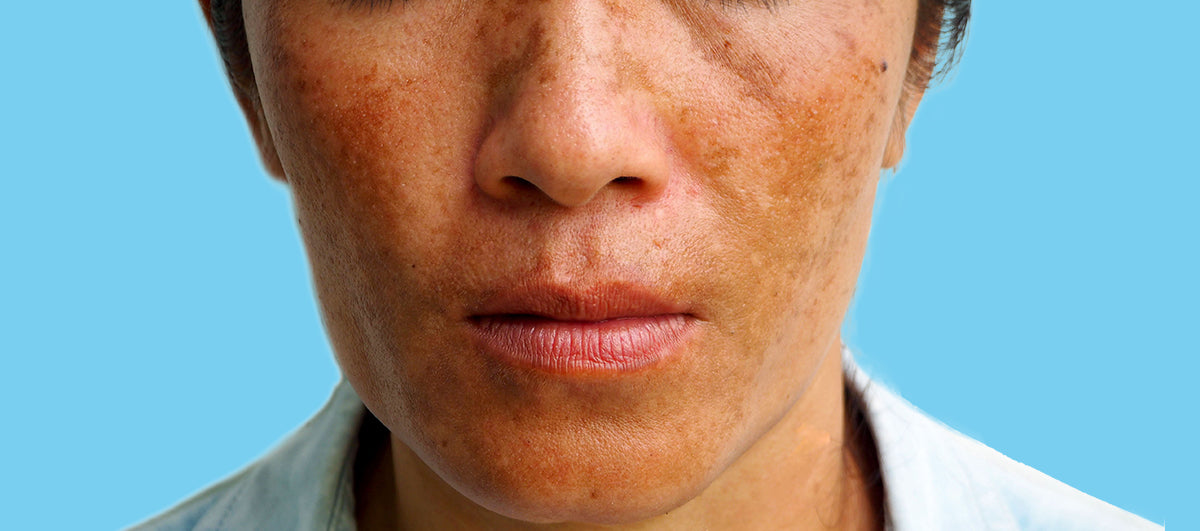 What Is Melasma?