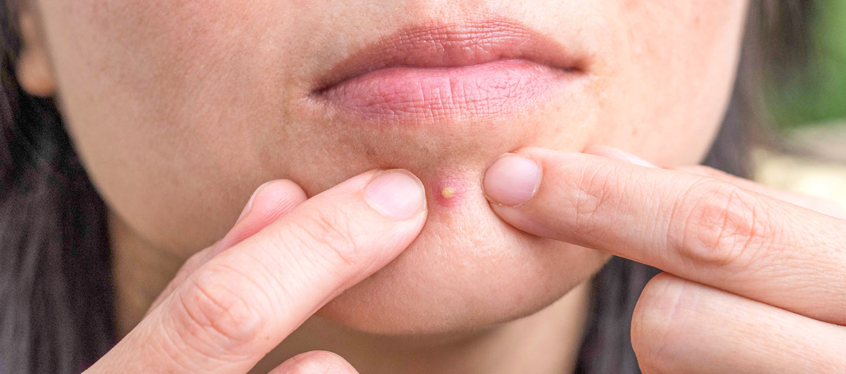 What To Do After You Pop A Pimple