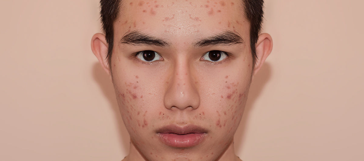 4 Powerful Ingredients To Clear Dark Spots Caused By Acne - Re'equil