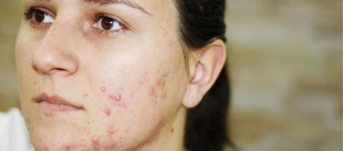 Acne online at 50