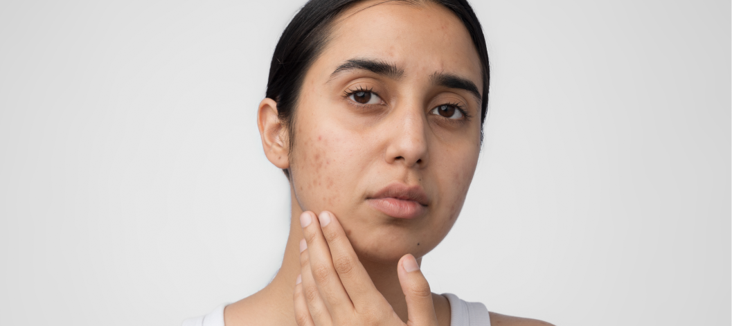 How Effective is Retinol for Treating Acne? - Re'equil